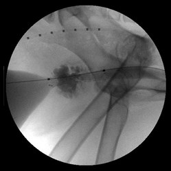 stent open stent open